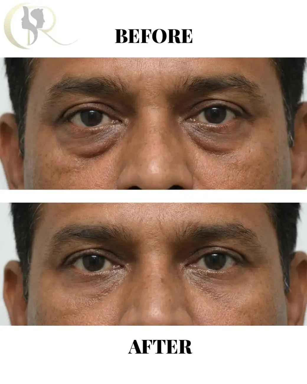 Cosmo Radiance result: Scarless Lower Eye Bag Removal
