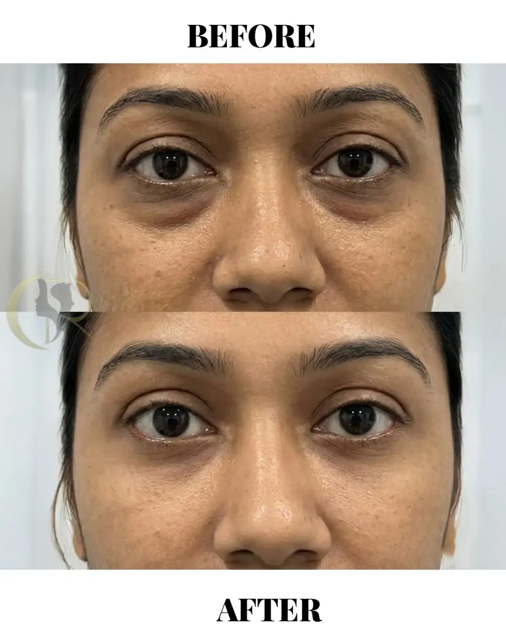 Cosmo Radiance result: Elite Under Eye Cosmetic Procedures