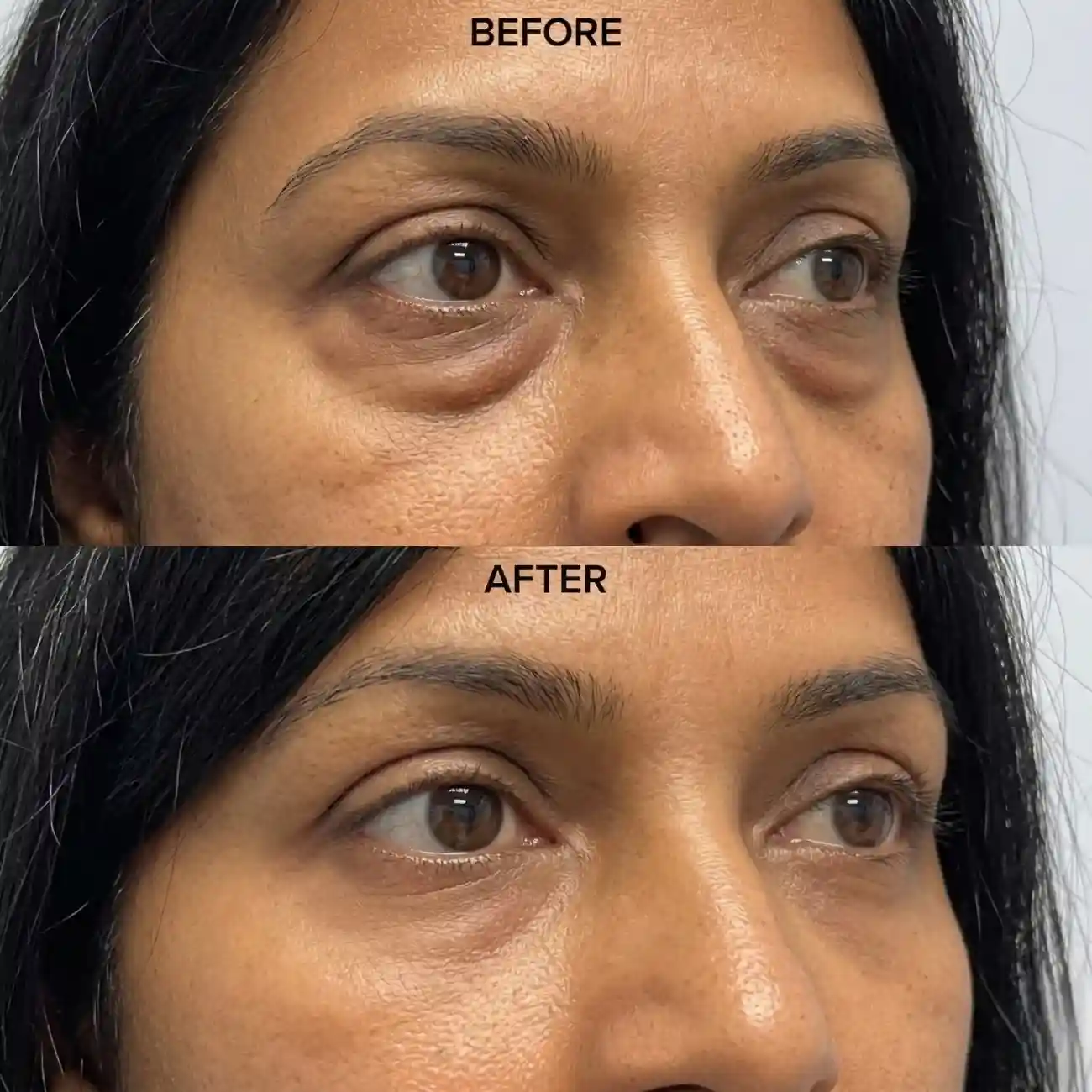 Cosmo Radiance result: Oblique View: Eye Bags Removal Surgery