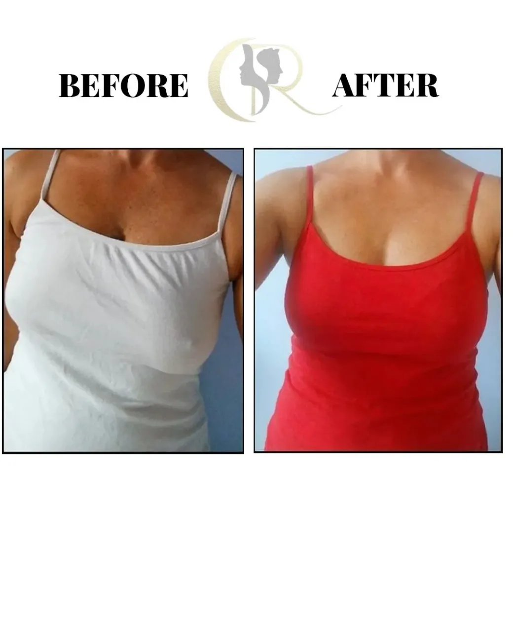 Cosmo Radiance result: Bra Bulge Removal Surgery & Symmetry