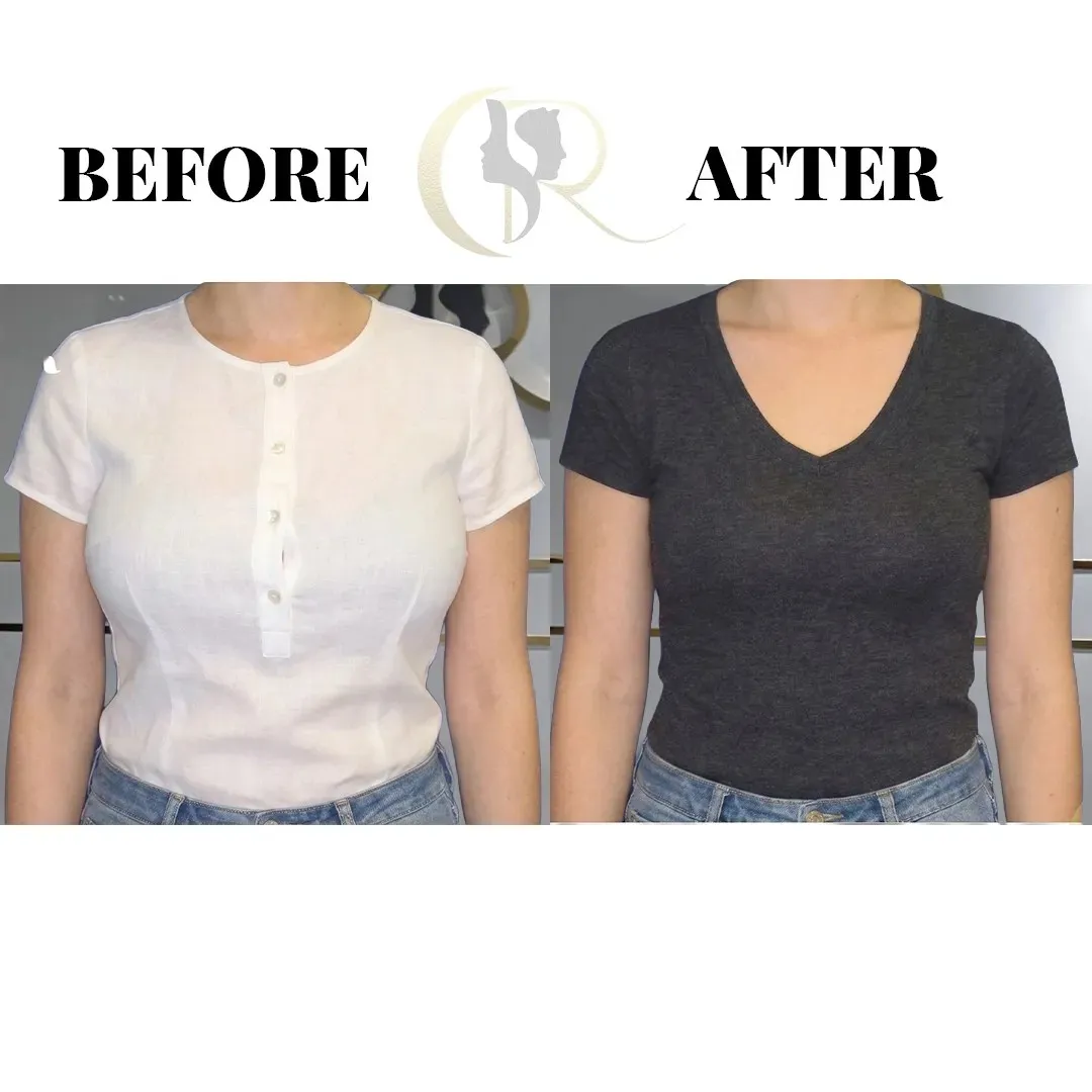 Cosmo Radiance result: Natural Breast Augmentation