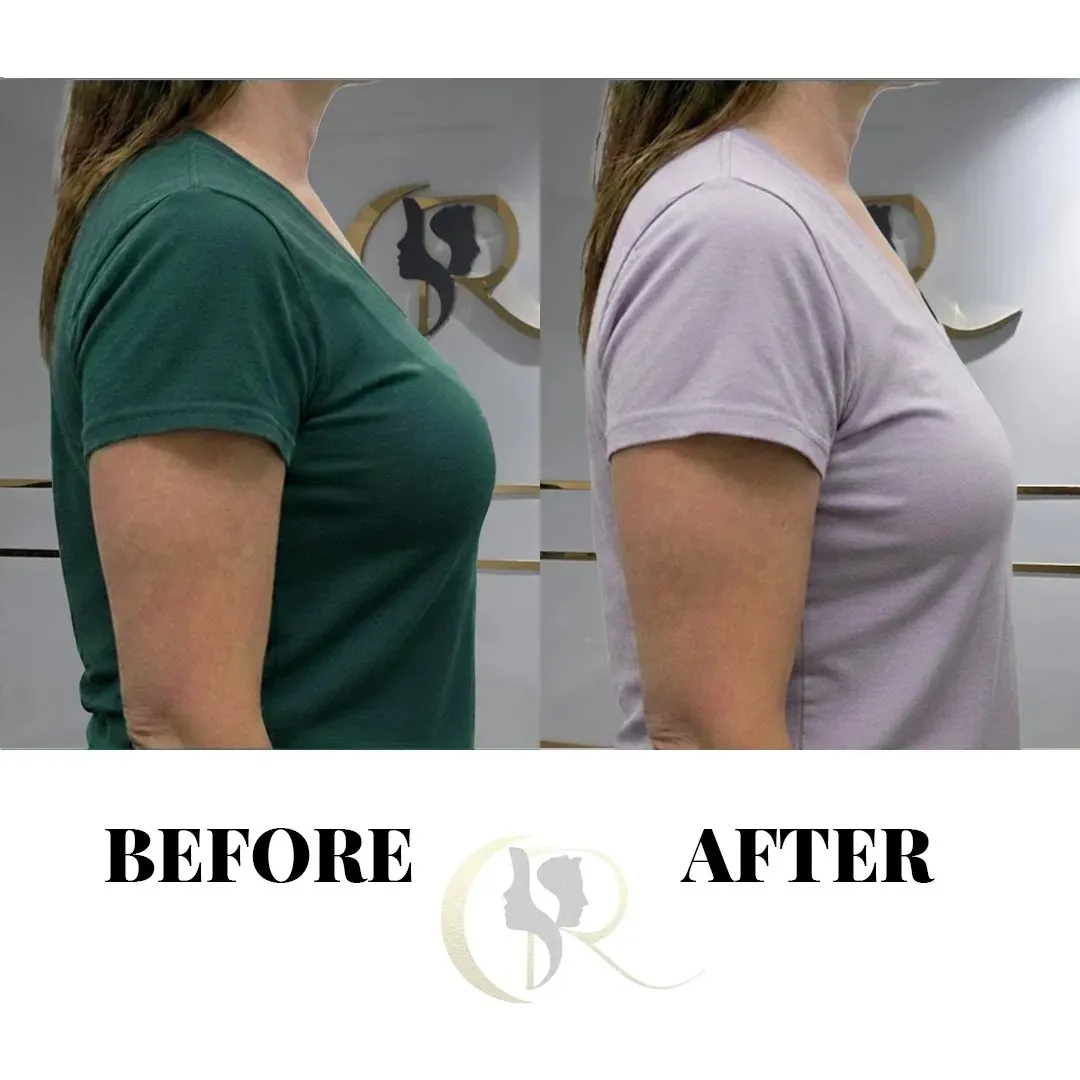 Cosmo Radiance result: Breast Sagging Treatment Surgery
