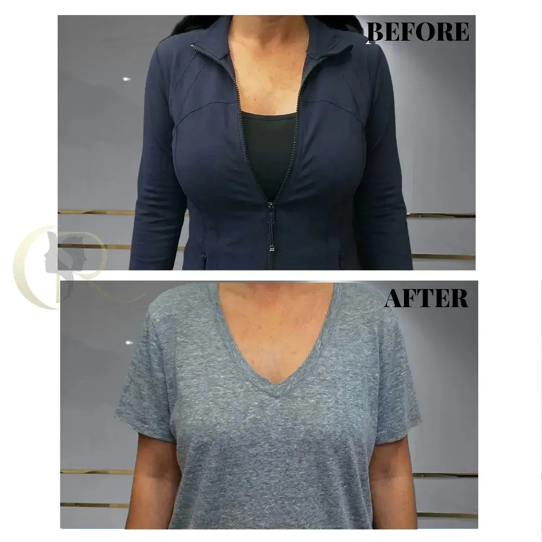 Cosmo Radiance result: Breast Reduction for Back Pain