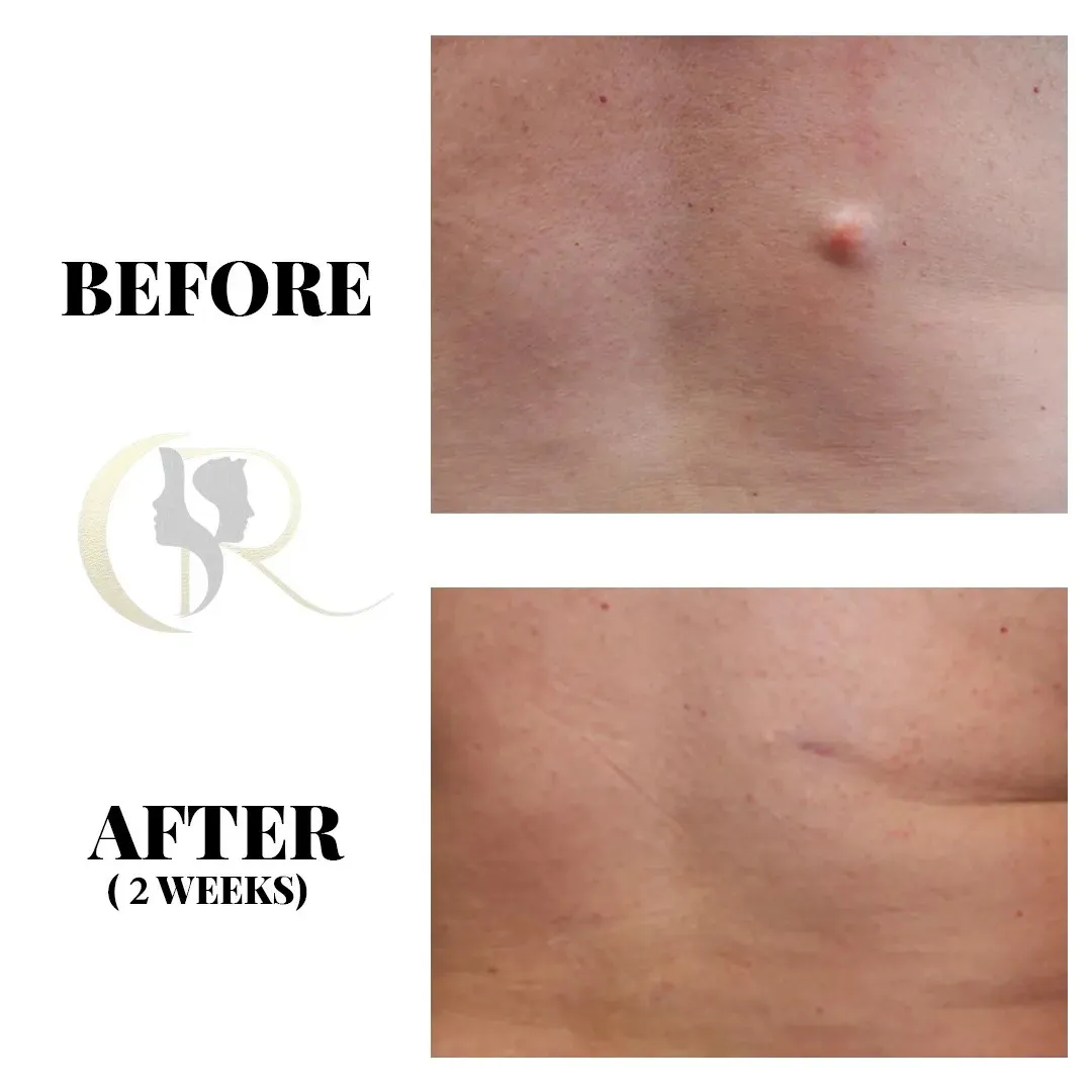 Cosmo Radiance result: Back Sebaceous Cyst Excision