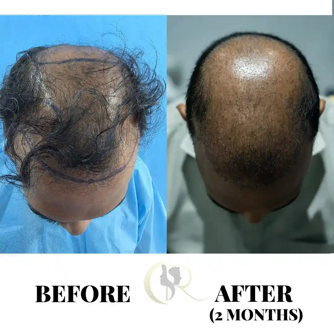 Cosmo Radiance result: Vertex & Frontal Filling