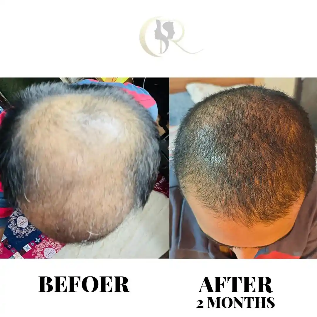 Cosmo Radiance result: Crown & Mid-Scalp Density
