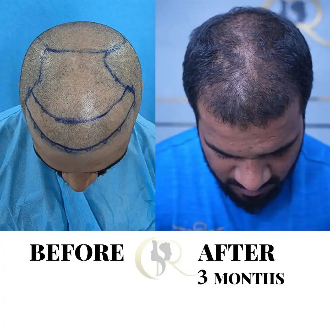 Cosmo Radiance result: Full Scalp Transformation