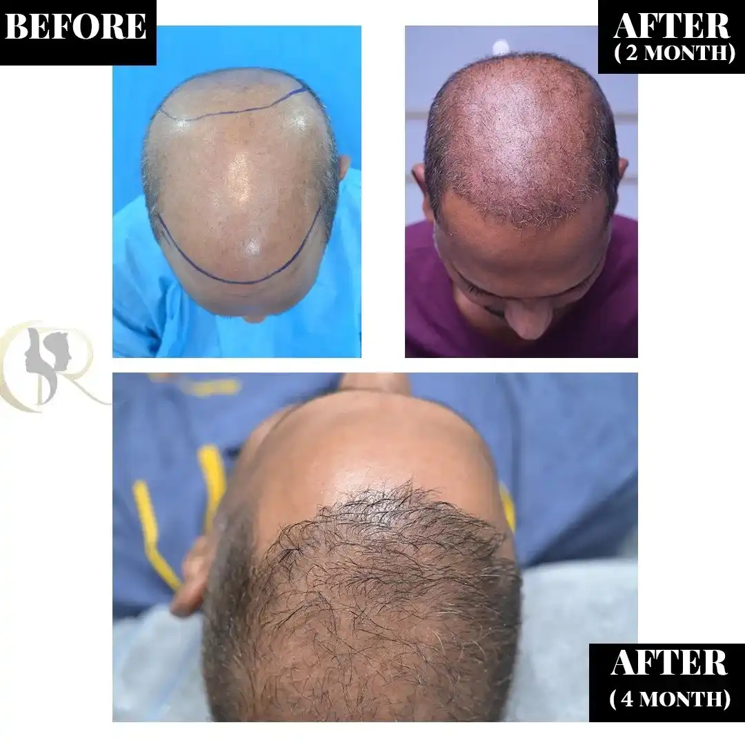 Cosmo Radiance result: Advanced Receding Hairline Fix