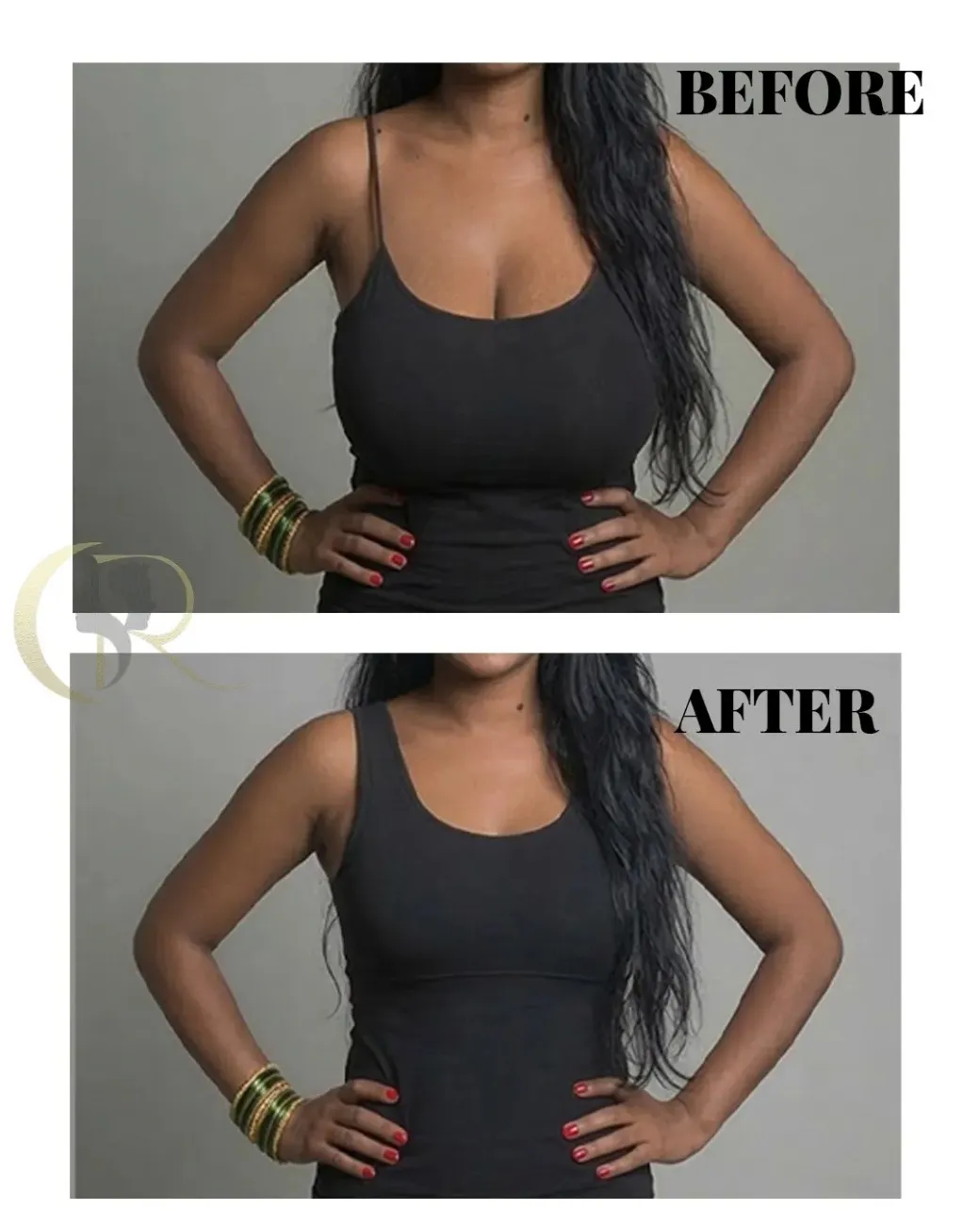 Cosmo Radiance result: Transformative Breast Reduction