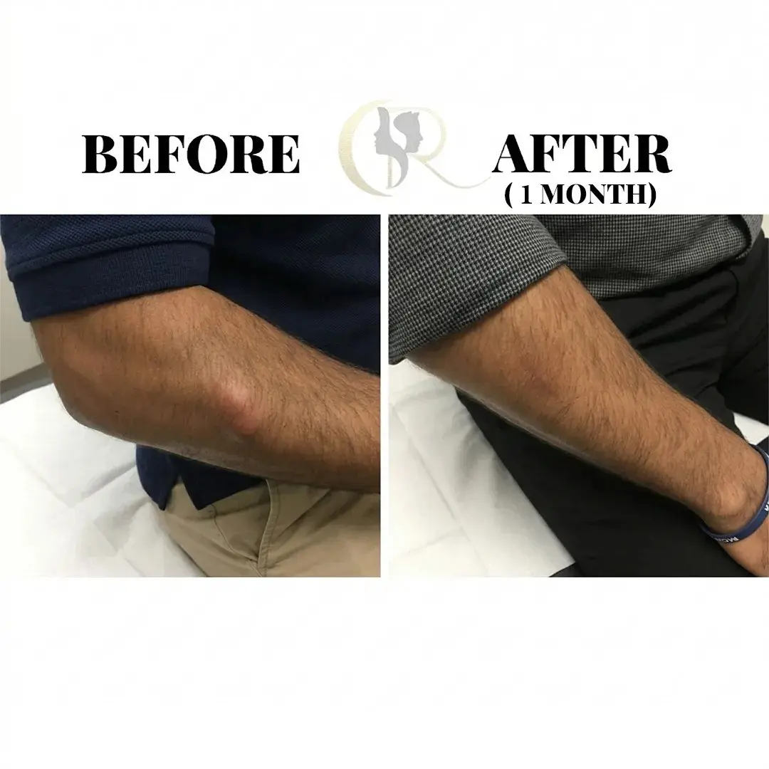 Cosmo Radiance result: Arm Fatty Lump Removal