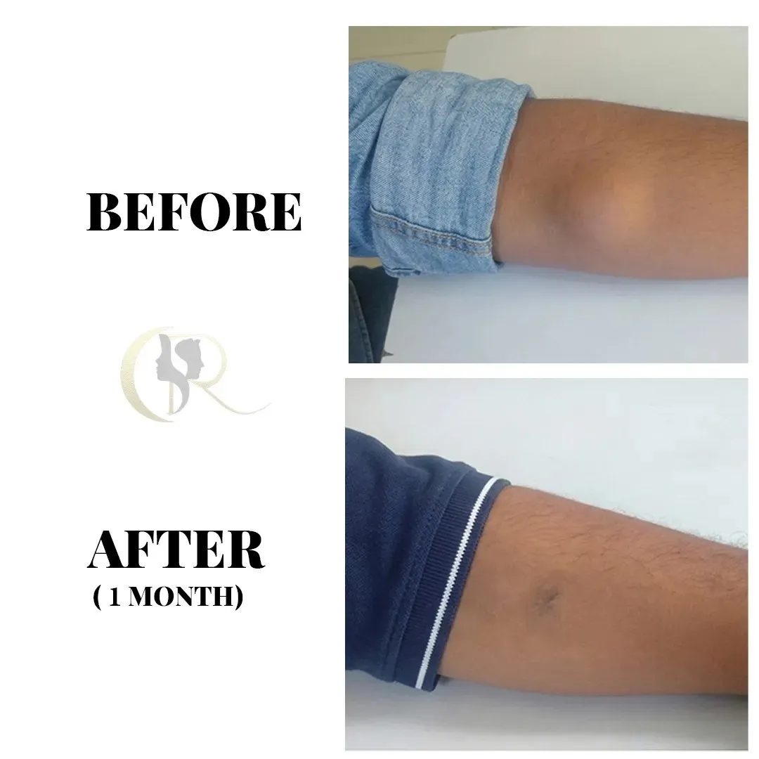 Cosmo Radiance result: Hand/Forearm Ganglion Extraction