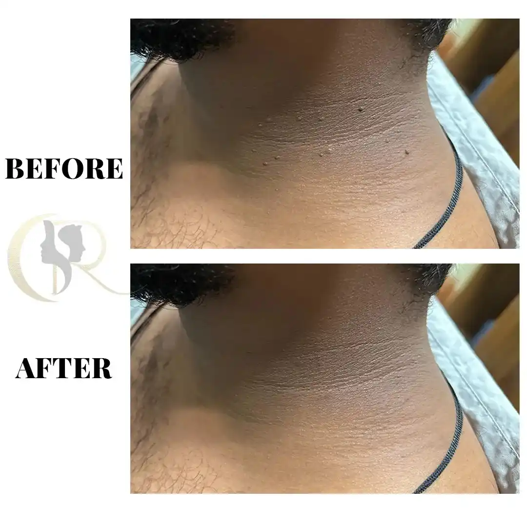 Cosmo Radiance result: Micro Skin Tag & Wart Removal on Face