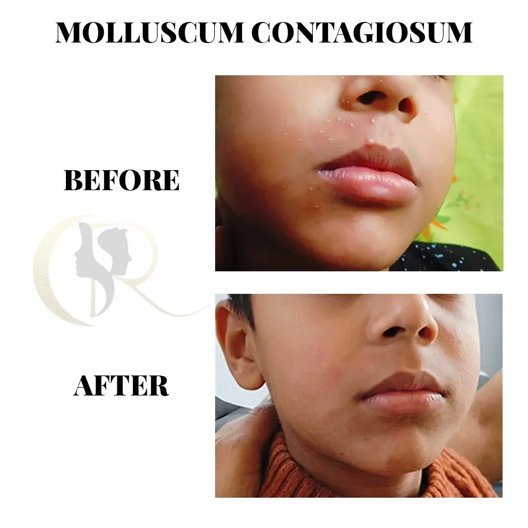 Cosmo Radiance result: Molluscum Contagiosum Treatment