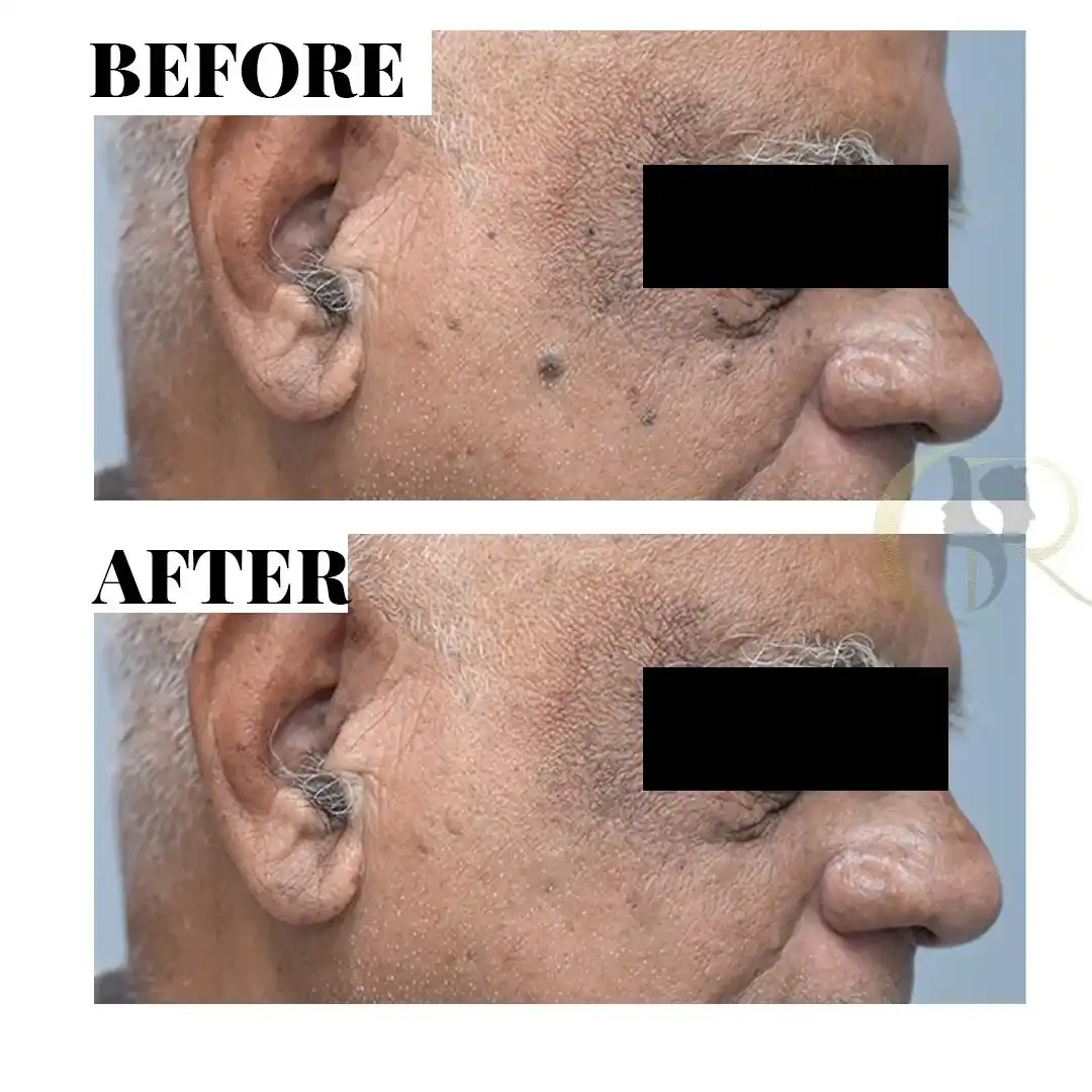Cosmo Radiance result: Seborrheic Keratosis & Dark Spot Removal