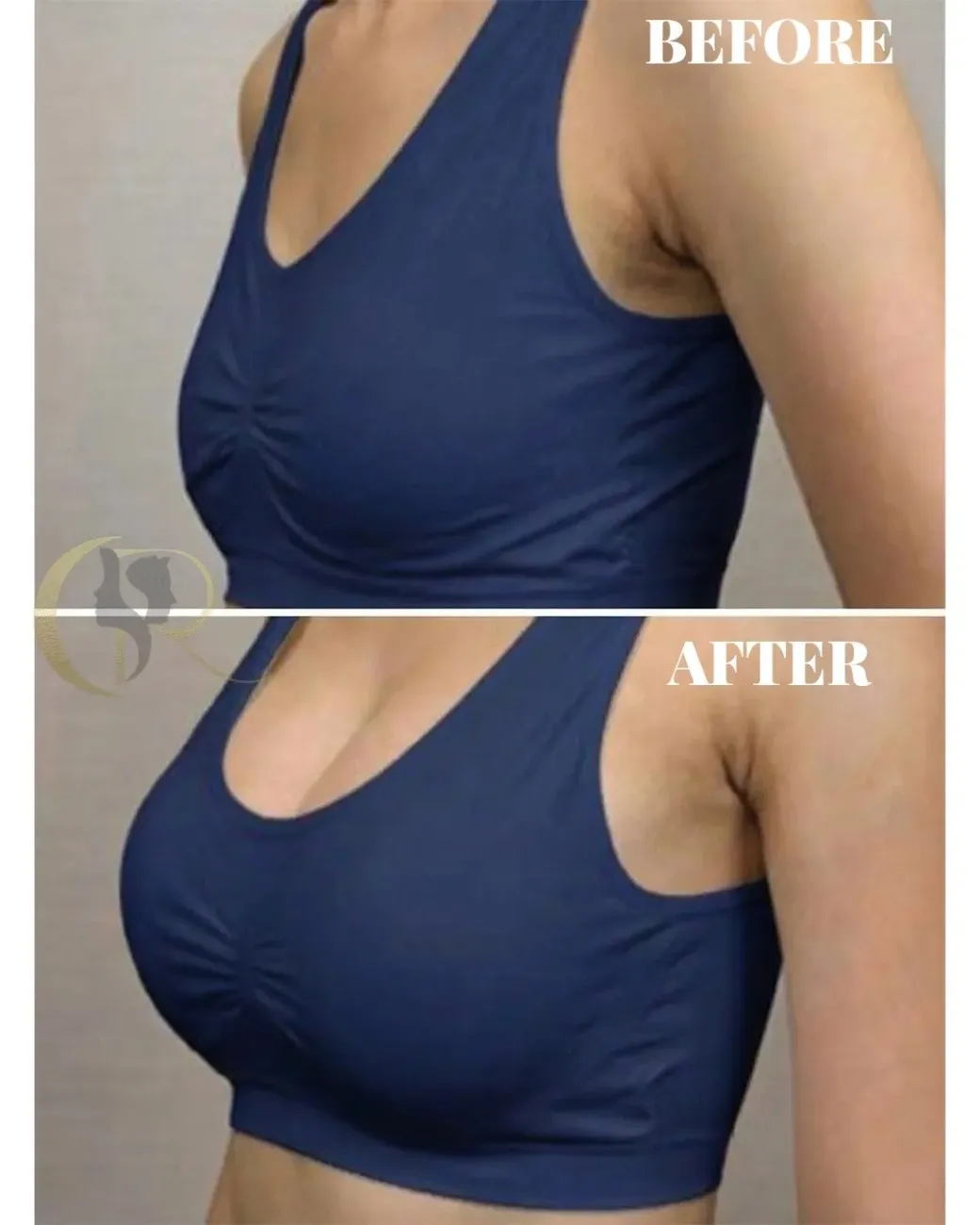 Cosmo Radiance result: Silicone Gel Breast Augmentation