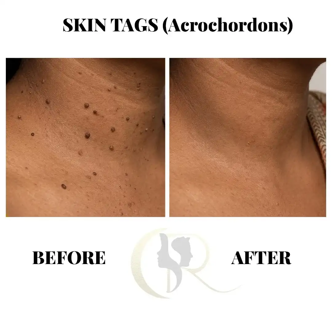 Cosmo Radiance result: Skin Tags (Acrochordons) Removal