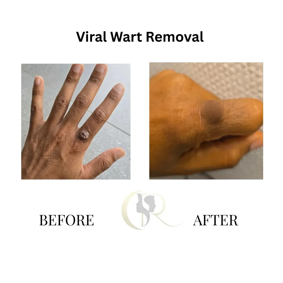 Cosmo Radiance result: Viral Wart Removal