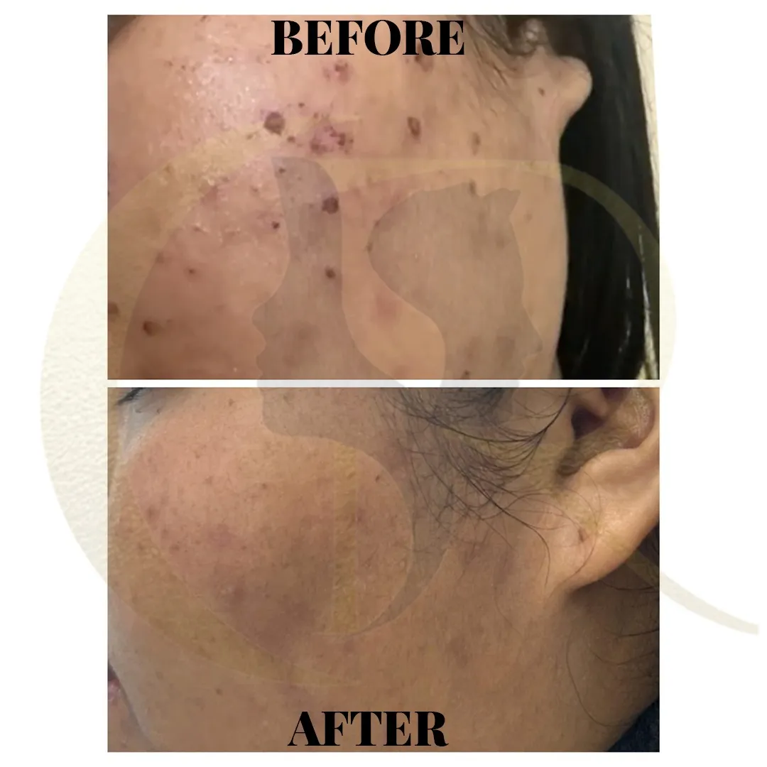Male acne scar removal using Fotona Starwalker MAQX and Candela CO2RE laser treatment result after 5 sessions in 3 months at Cosmo Radiance Hyderabad India