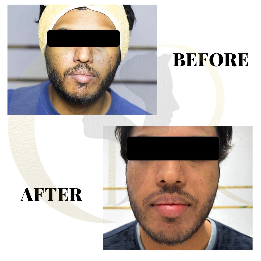 Acne scar treatment result 3 months post-procedure using MNRF Scarlet S, Fotona Starwalker, Subcision, and Candela CO2RE at Cosmo Radiance Hyderabad India