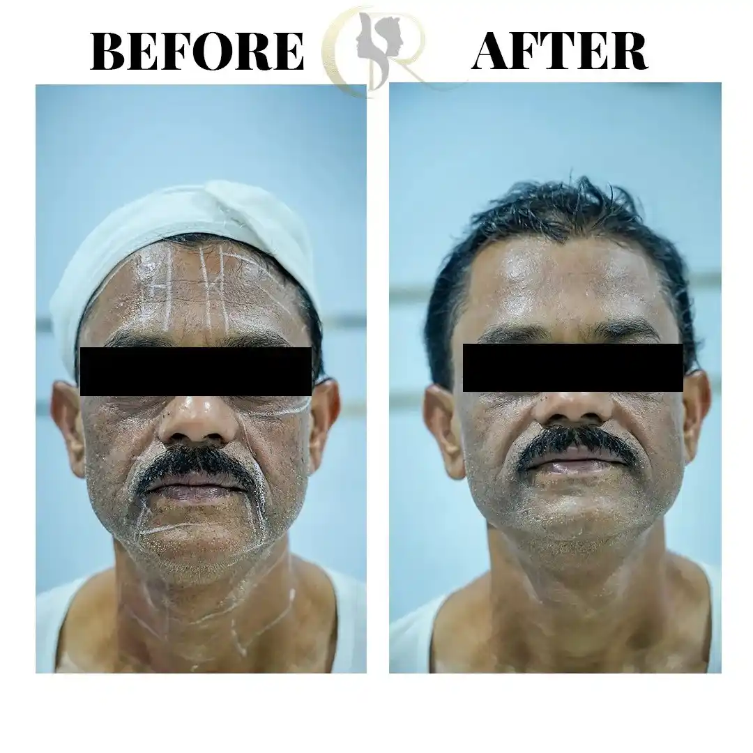 Male anti-aging robotic face lift before and after result using Ultraformer MPT showing skin tightening at Cosmo Radiance Hyderabad India