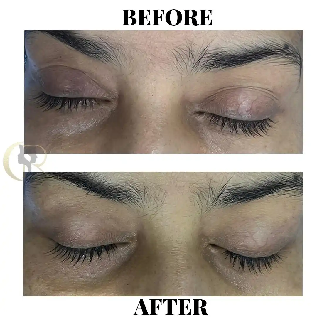 Deep Plane Facelift vs. Mini Facelift: Anatomy, Longevity & Recovery Differences