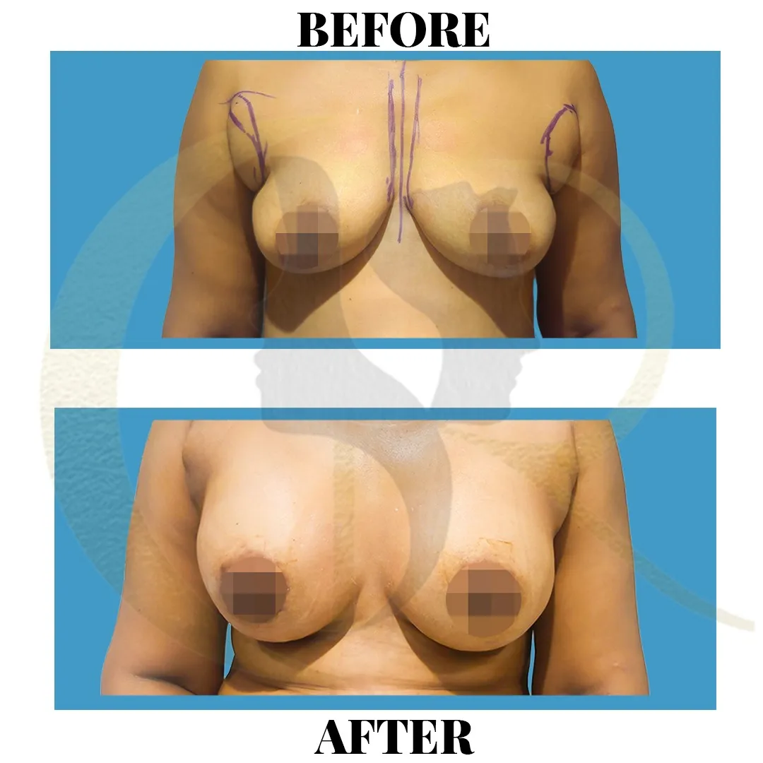 Breast augmentation with Motiva implants showing post-surgery Day 10 result using Vectra H2 Body Imaging at Cosmo Radiance Hyderabad India