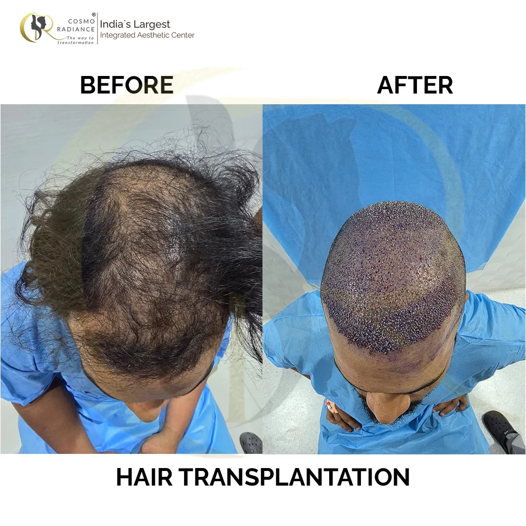 Hair transplant result showing graft density 10 days after surgery at Cosmo Radiance Hyderabad India