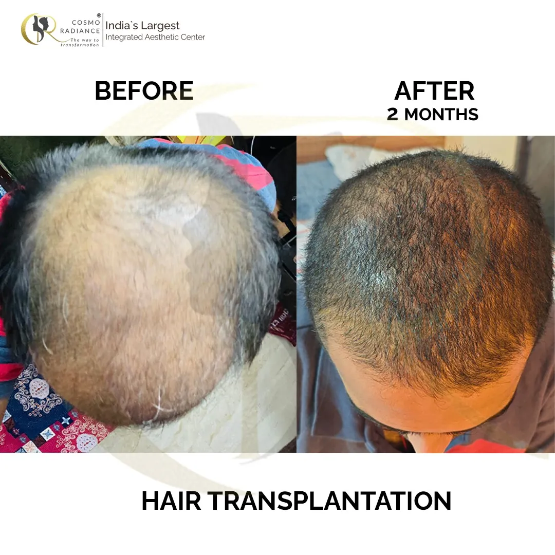 Hair transplant result showing improved hair density 2 months after FUE + DHI procedure at Cosmo Radiance Hyderabad India