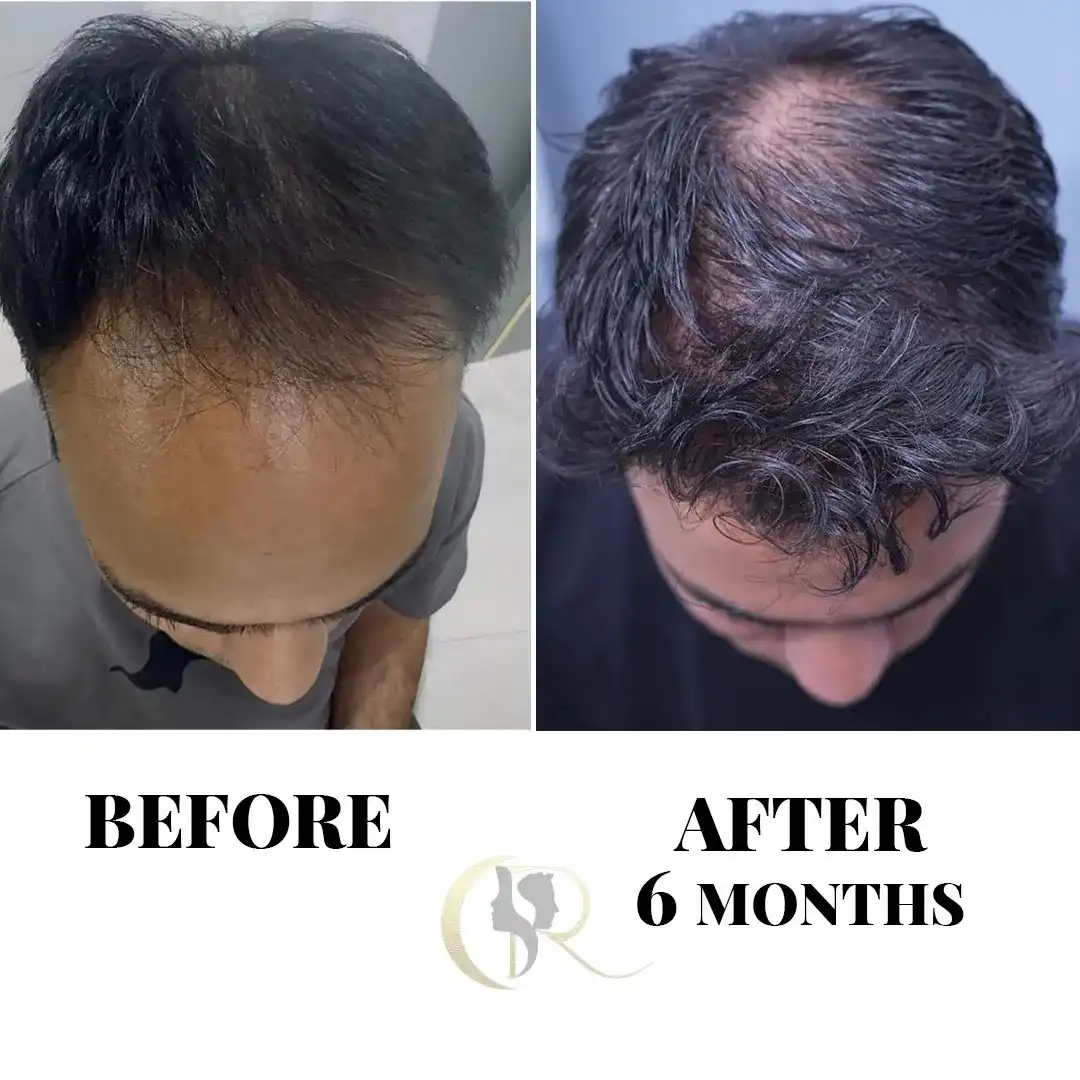 Hairline restoration showing significant hair growth 6 months after FUE + DHI hair transplant at Cosmo Radiance Hyderabad India