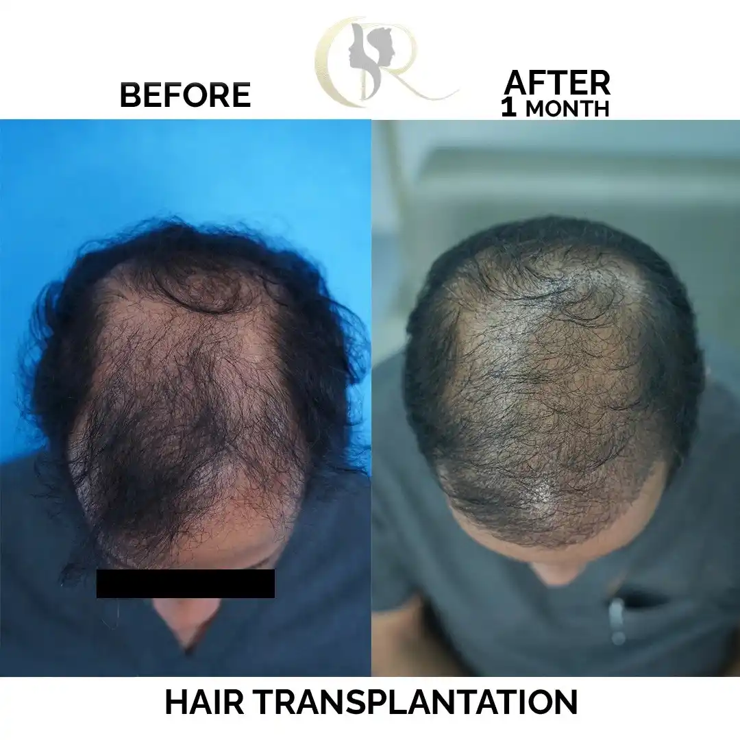 Advanced Body Hair Transplant (BHT) in Hyderabad | Beard to Scalp Cost