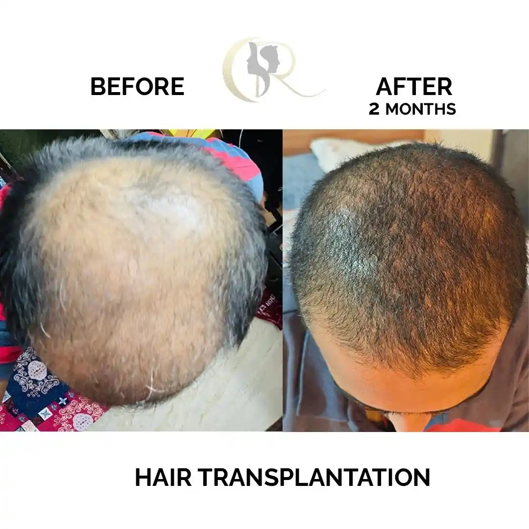 Hair transplant result showing improved hair density 2 months after FUE + DHT procedure at Cosmo Radiance Hyderabad India