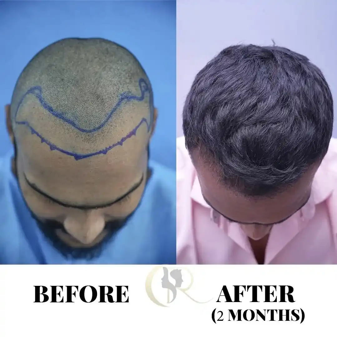 Hair transplant result showing donor and recipient areas on Day 2 months post-surgery at Cosmo Radiance Hyderabad India