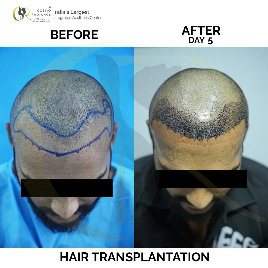 Hair transplant result showing donor and recipient areas on Day 1 post-surgery at Cosmo Radiance Hyderabad India