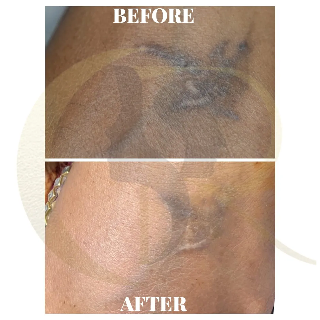Laser tattoo removal result after 4 sessions using Fractat Fotona Starwalker MAQX and Candela CO2RE at Cosmo Radiance Hyderabad India