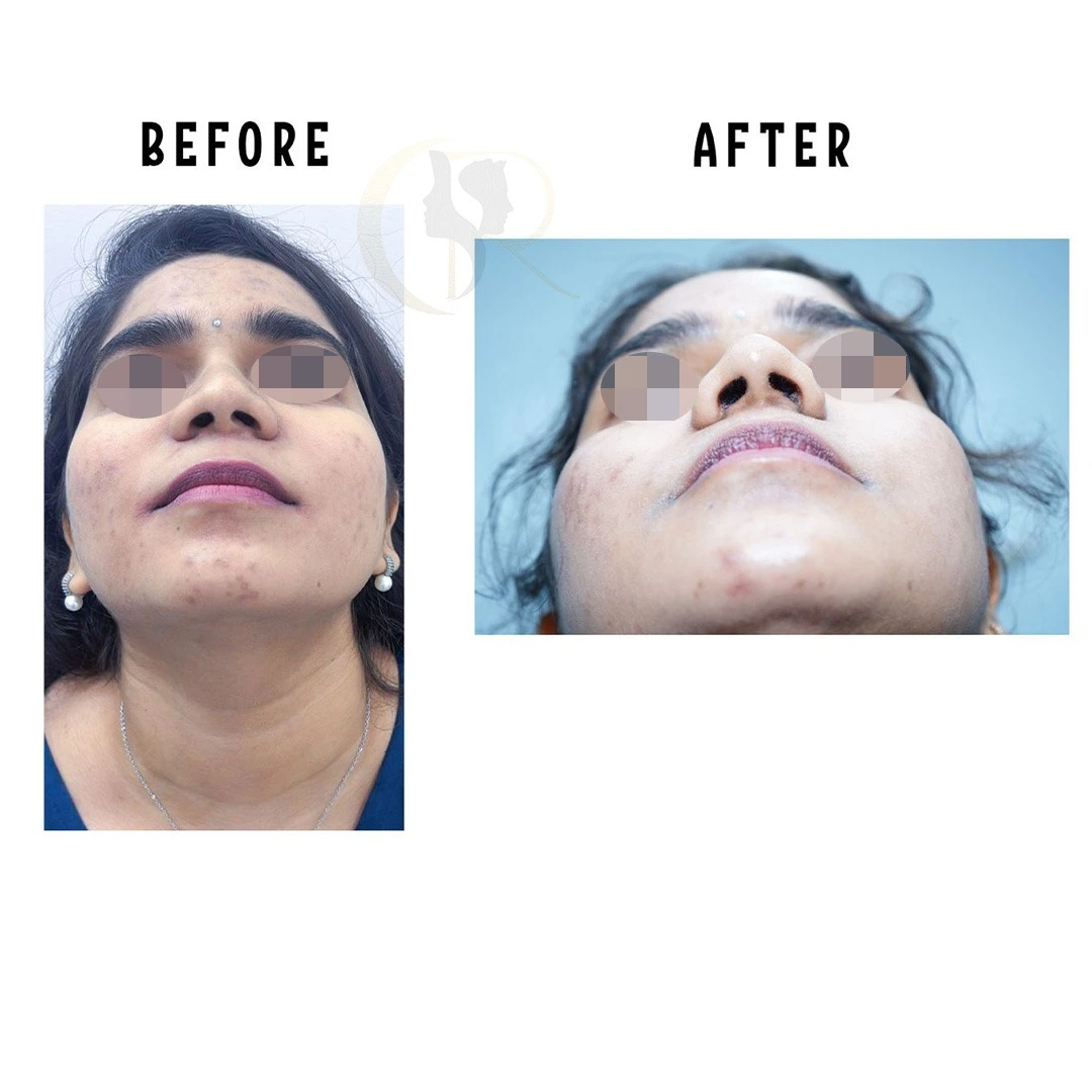 Non-surgical rhinoplasty result showing improved nasal contour at Cosmo Radiance Hyderabad India
