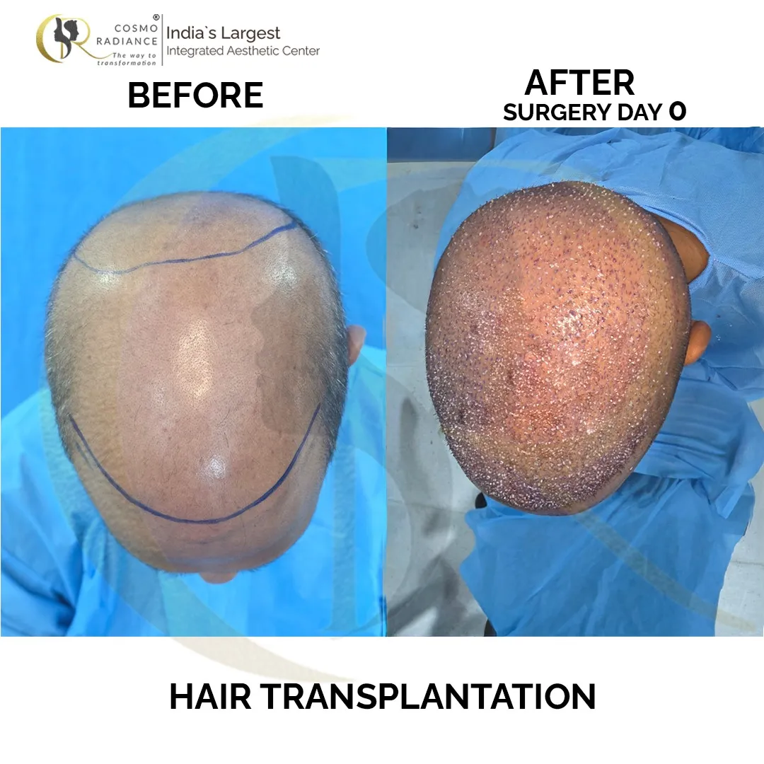 Hair transplant immediate post-op day 0 showing donor and recipient areas after FUE procedure at Cosmo Radiance Hyderabad India