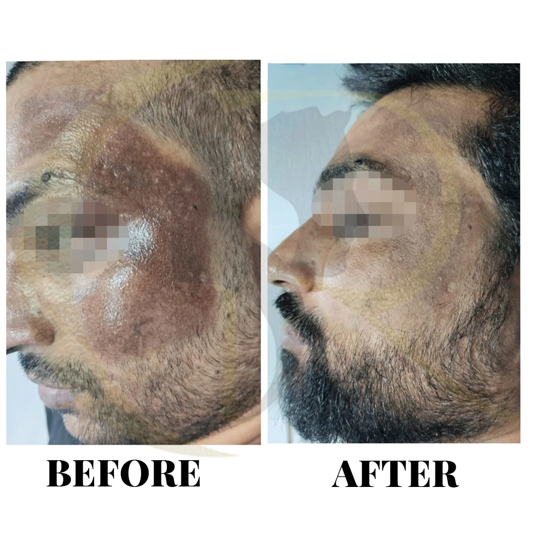 Skin pigmentation treatment using Fotona Starwalker MAQX and Angel Whitening plus chemical peels result after 5 sessions in 3 months at Cosmo Radiance Hyderabad India