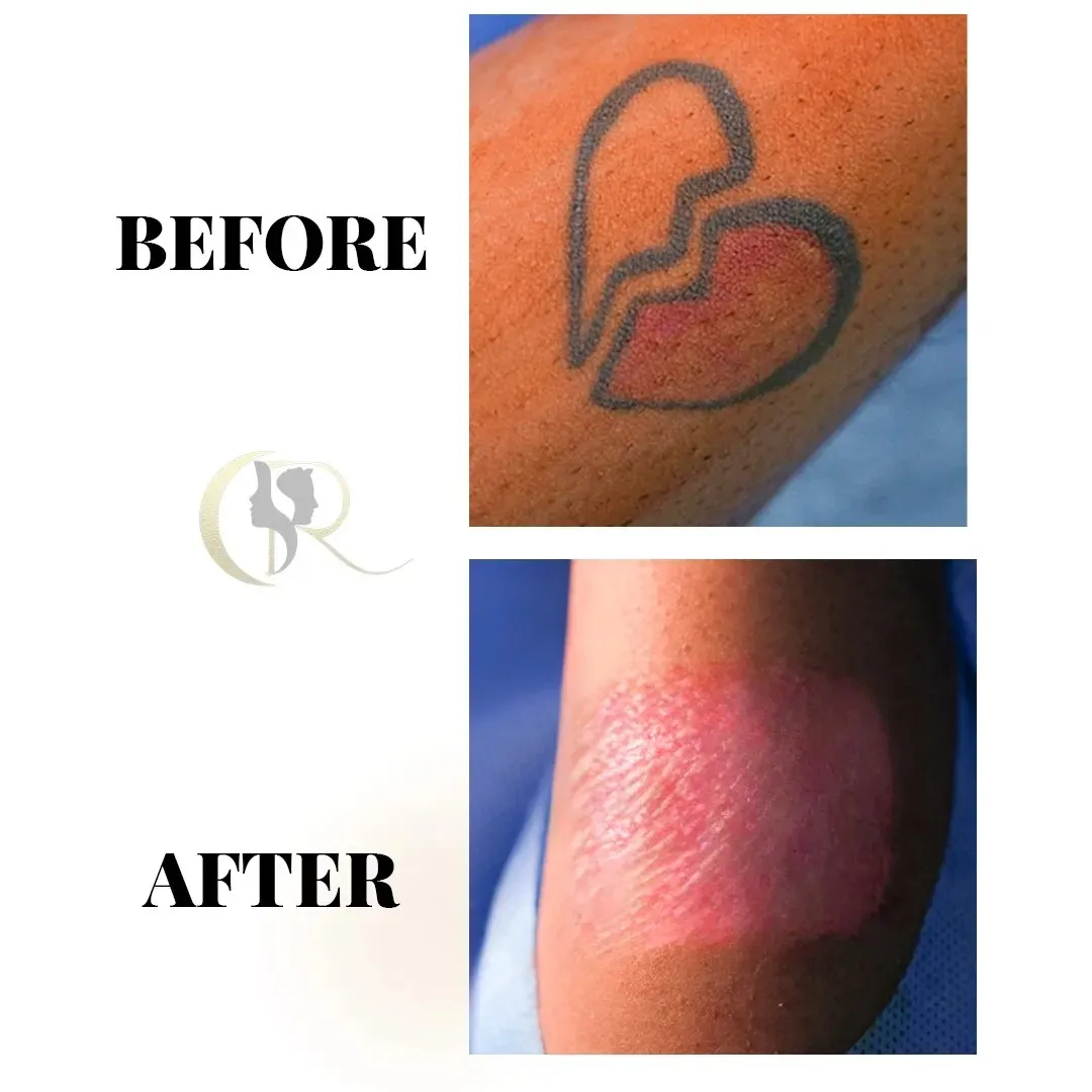 Single session ablative laser tattoo removal result on shoulder showing immediate clearance at Cosmo Radiance Hyderabad India