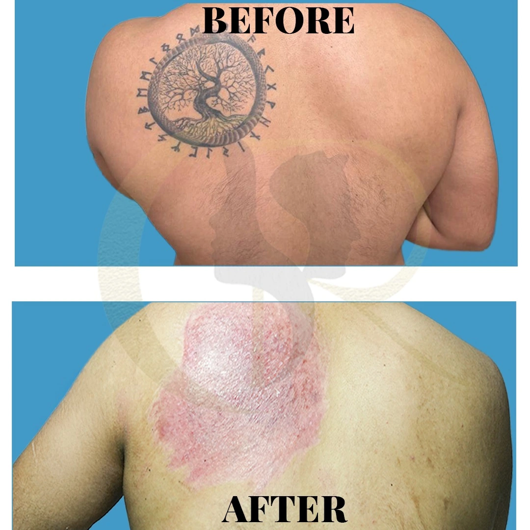 Tattoo removal single session ablative resurfacing result for emergency removal at Cosmo Radiance Hyderabad India