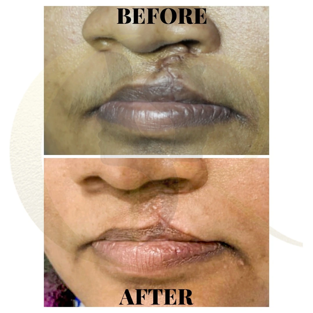 Cleft lip scar revision result after 5 sessions of integrated CO2 laser and ILS 5-FU treatment at Cosmo Radiance Hyderabad India