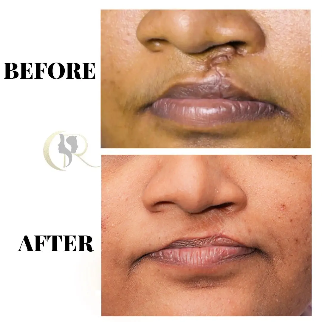 Cleft Lip Scar Revision - Integrated Treatment (5 Sessions)