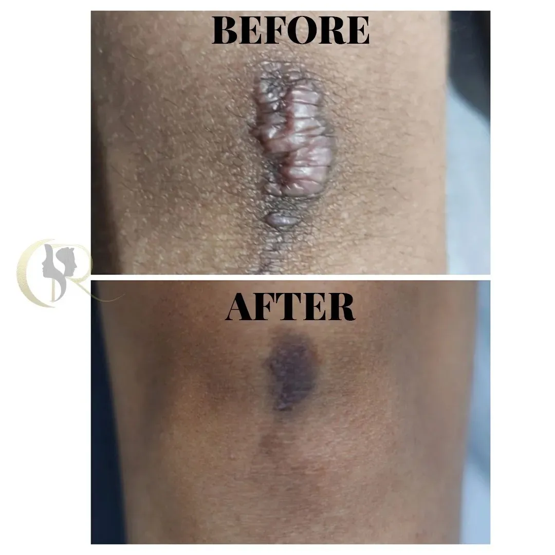 Keloid Scar Treatment - 5 Sessions Result