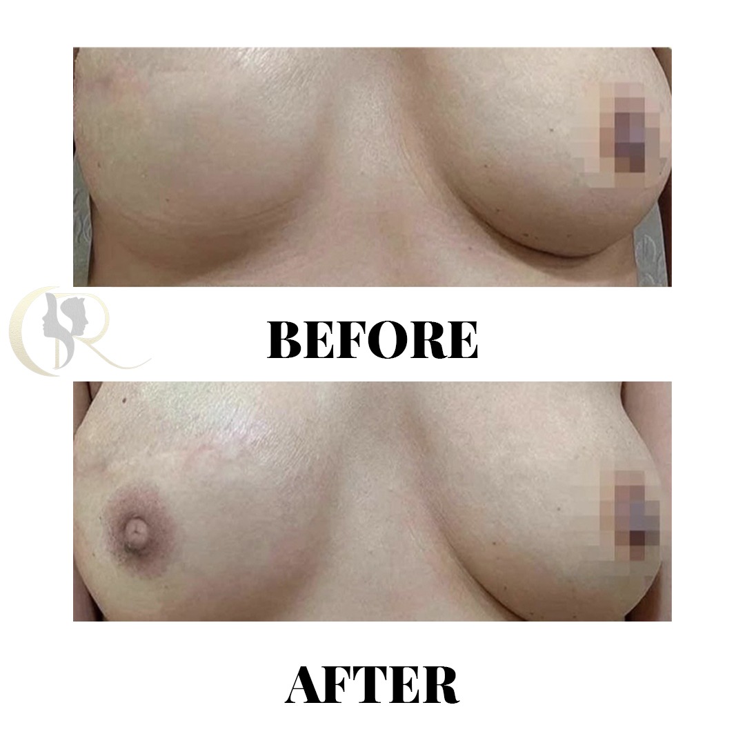 3D Areola and Nipple Complex Reconstruction Before and After