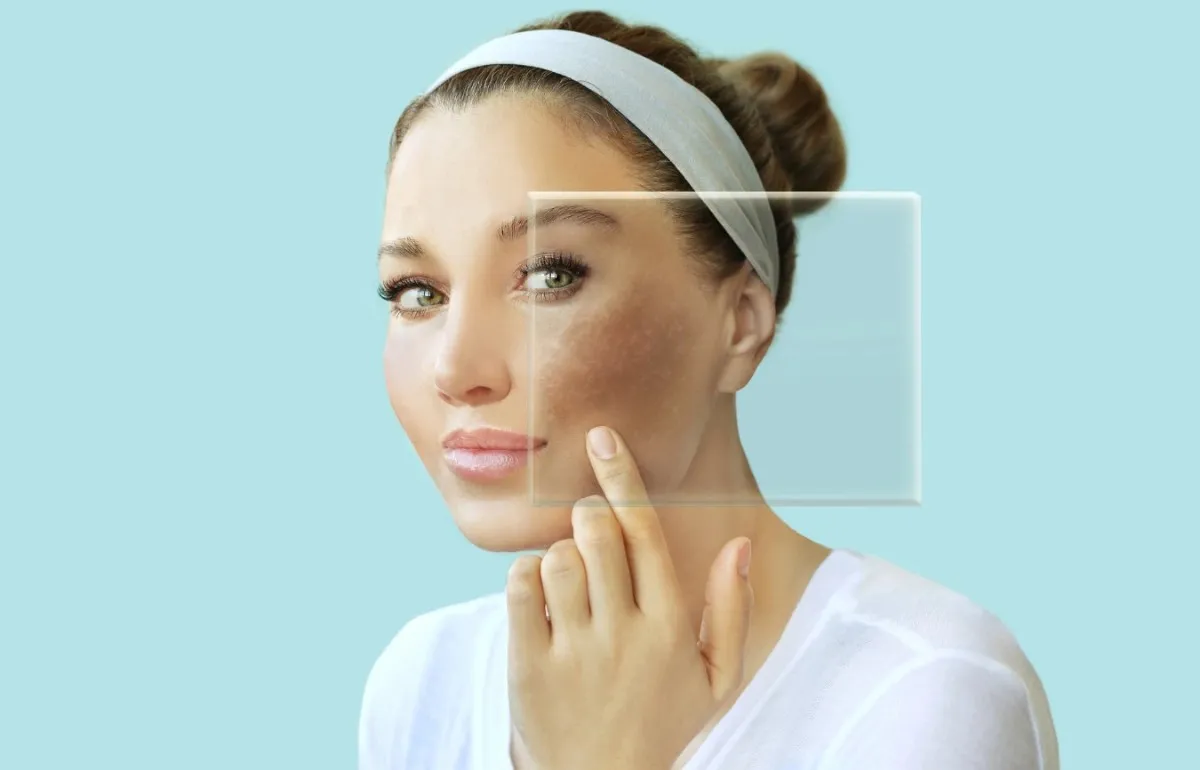 Understanding Laser Skin Treatments in Hyderabad: Pigmentation, Melasma, Scars & Skin Phototypes
