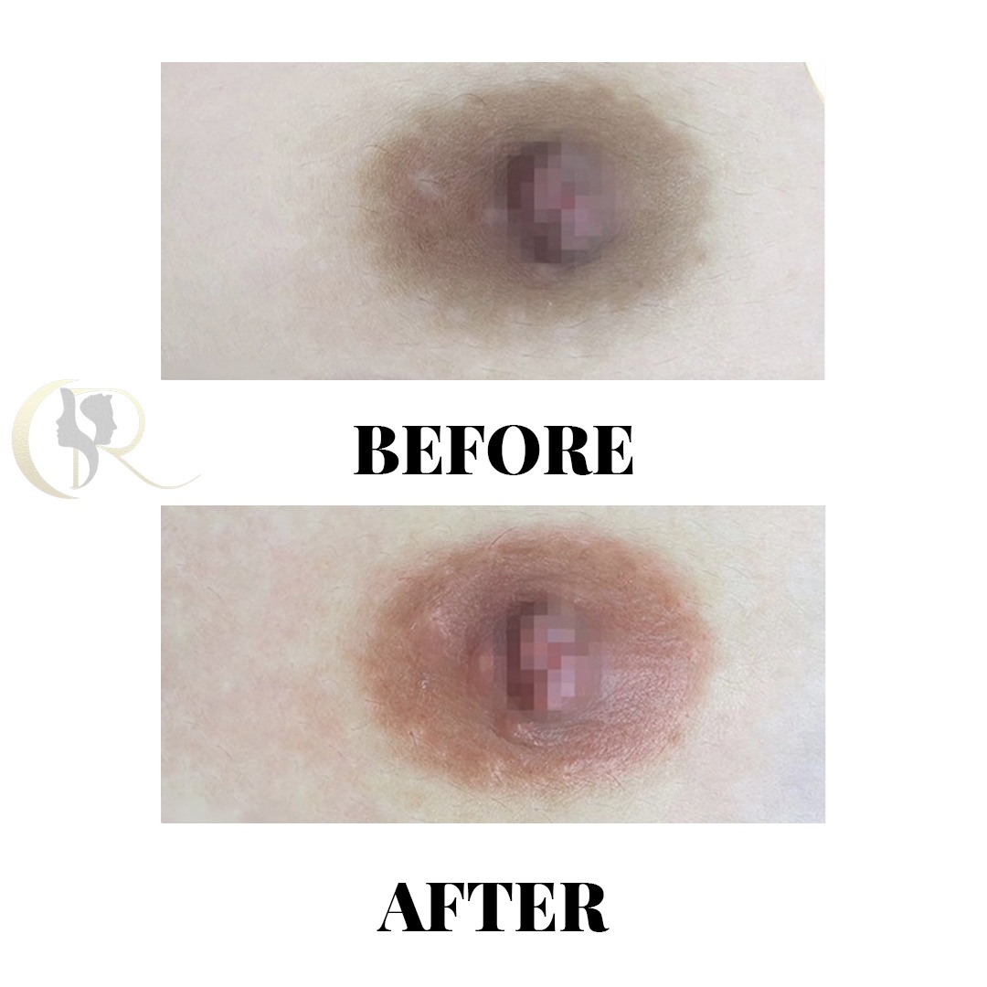 Areola Color Correction and Lightening Before and After