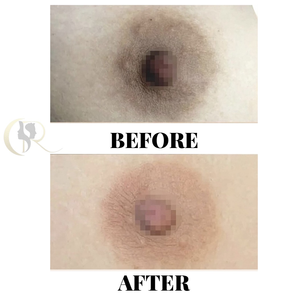 Areola Tone Restoration Before and After