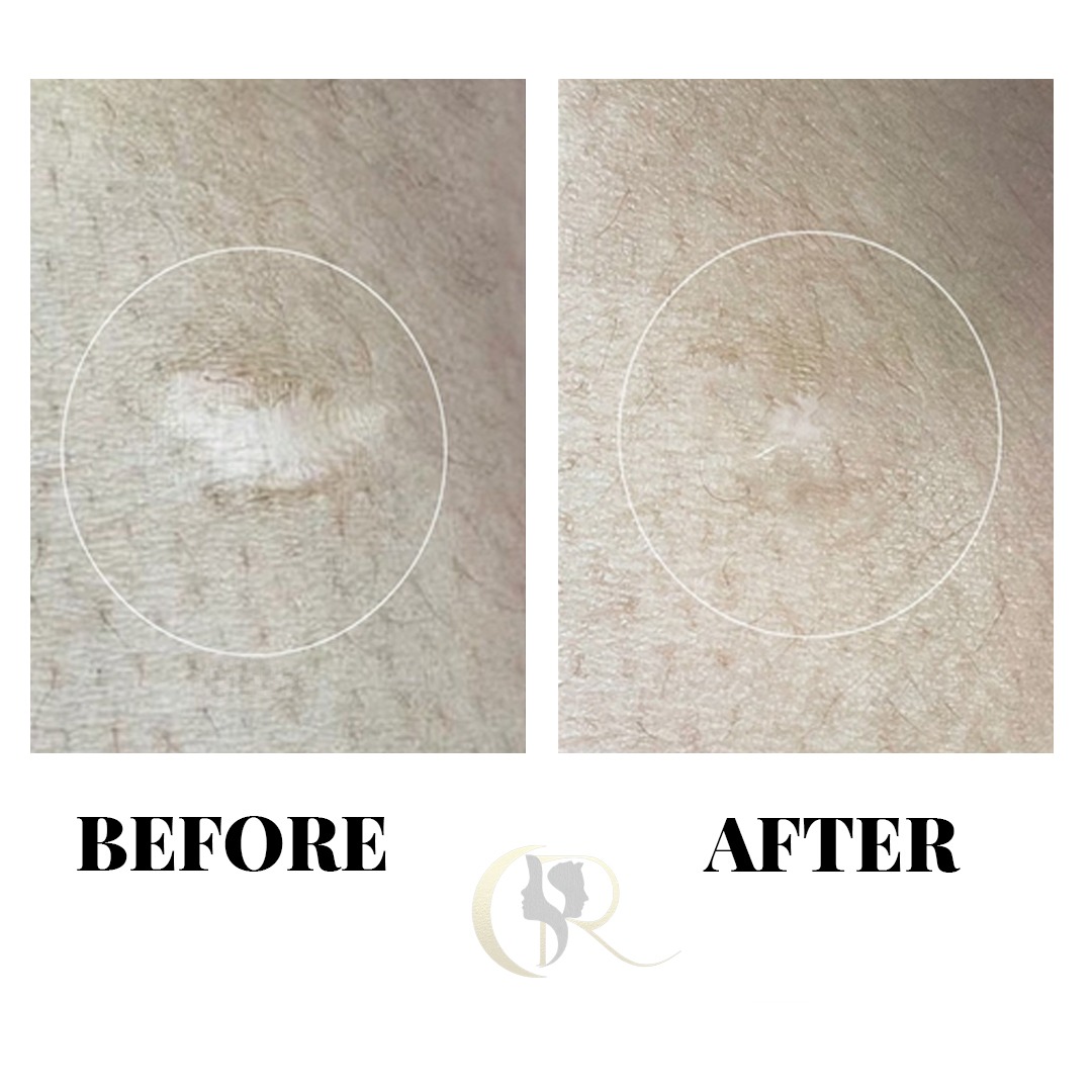 Atrophic Circular Scar Camouflage Before and After