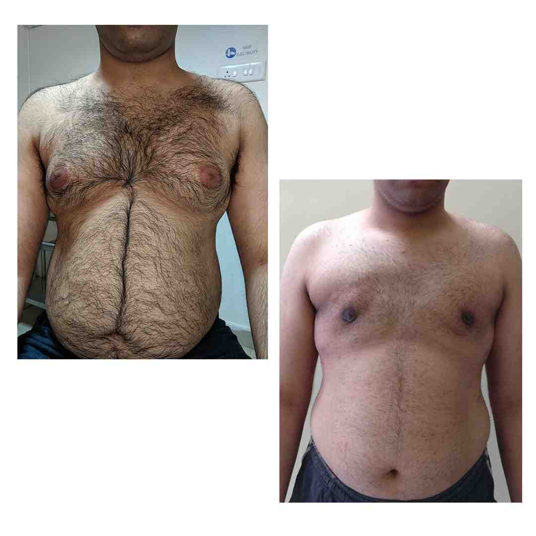 Before and after US & Europe NRI Homecoming Plastic Surgery Clinic in Hyderabad: Keyhole Male Chest Sculpting Transformation at Cosmo Radiance Hyderabad