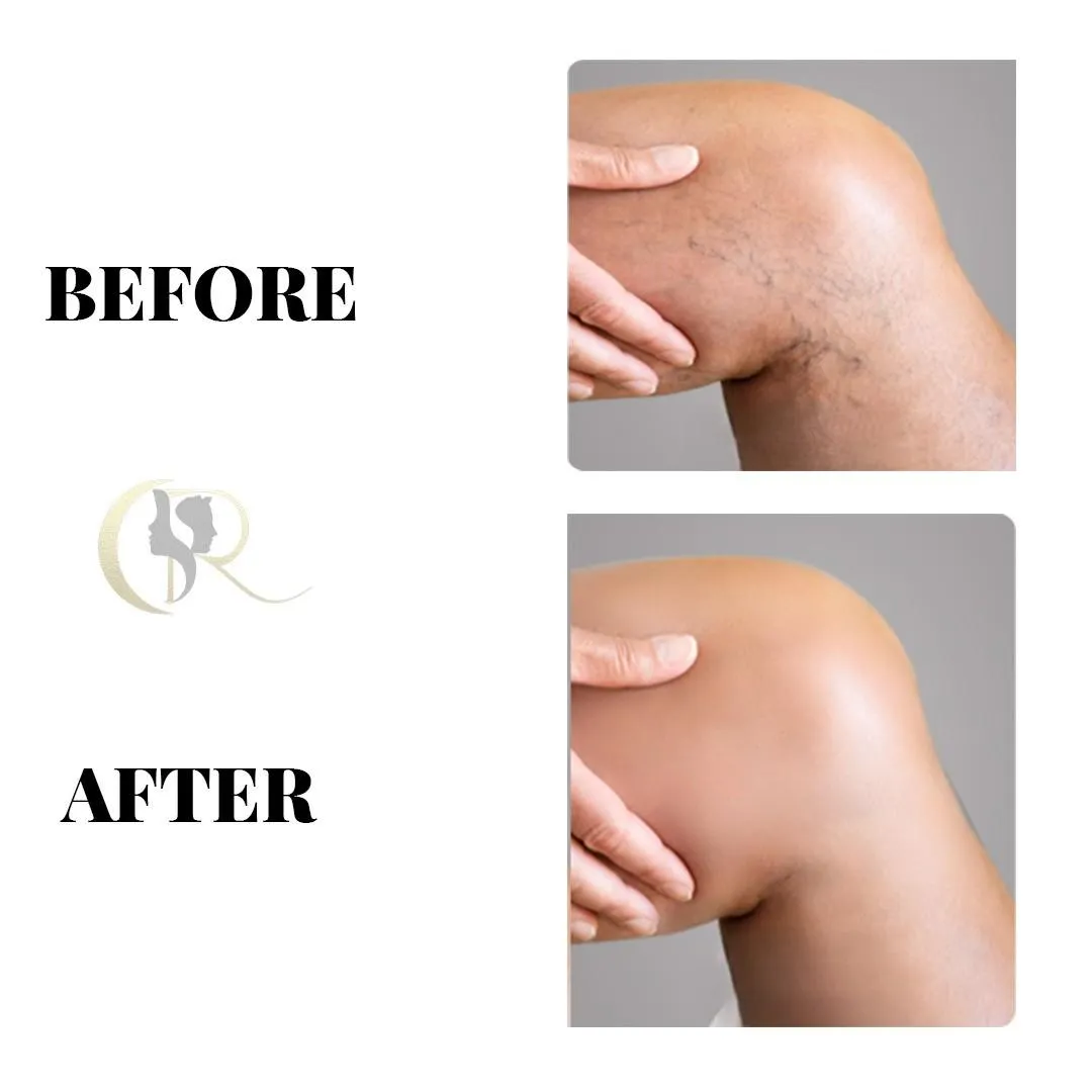 Best Varicose Veins Treatment in Hyderabad | 0% EMI
