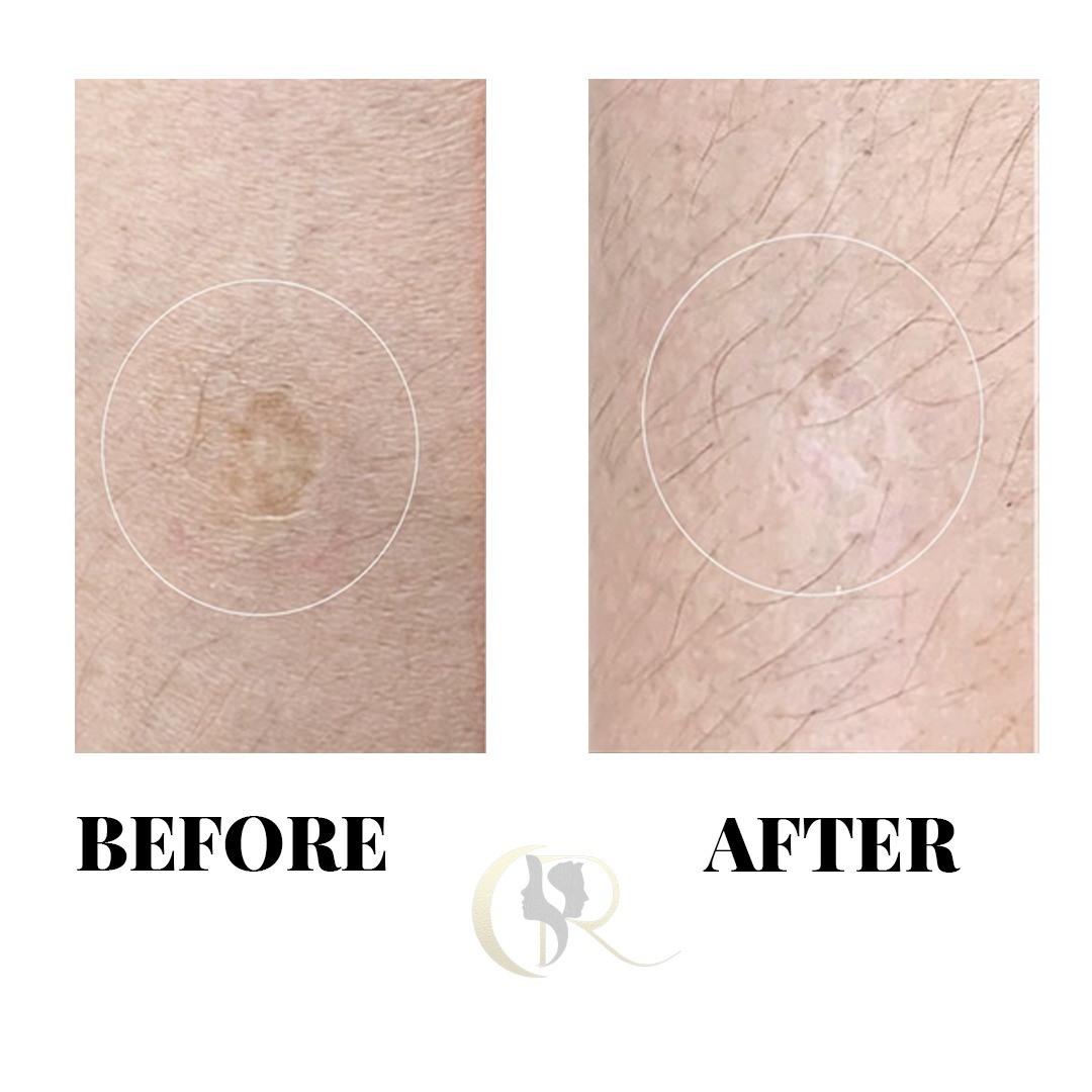 Dermal Scar Camouflage Before and After